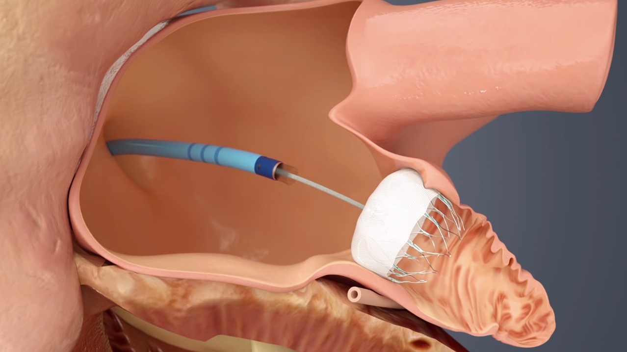 Left atrial appendage closure – Winelands Cardiology