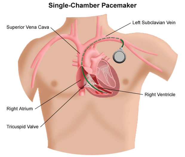 Pacemakers – Winelands Cardiology